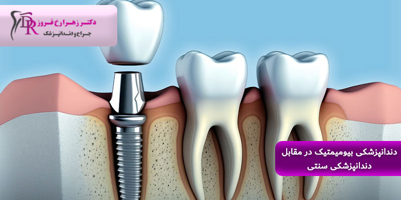ایمپلنت دندان چیست و چه کاربردی دارد؟