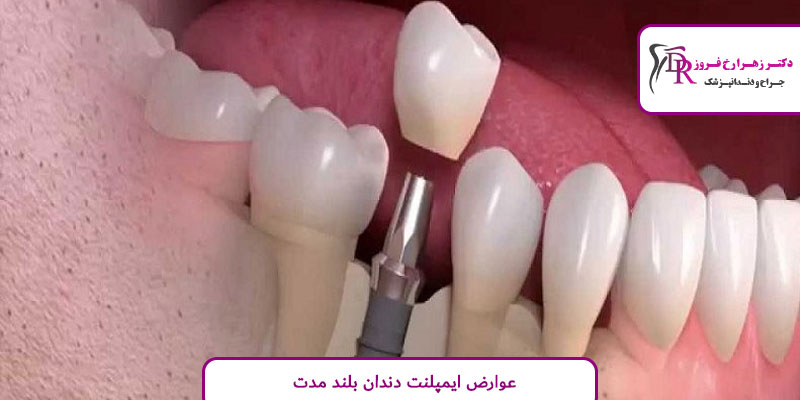 عوارض ایمپلنت دندان بلند مدت
