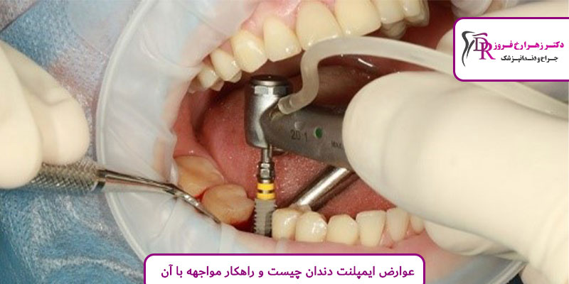 عوارض ایمپلنت دندان چیست و راهکار مواجهه با آن