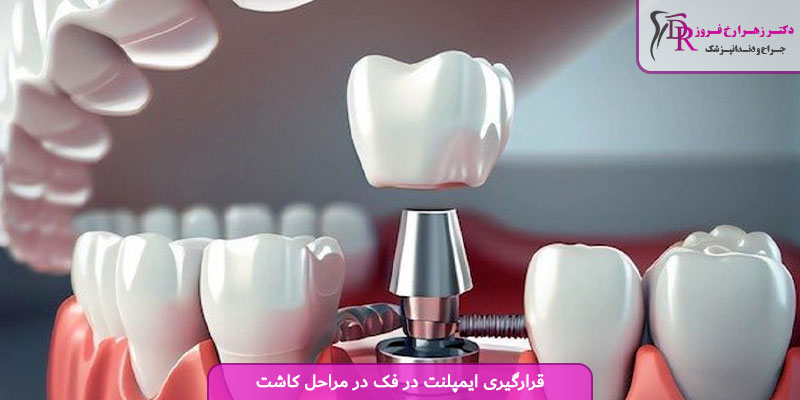قرارگیری ایمپلنت در فک در مراحل کاشت