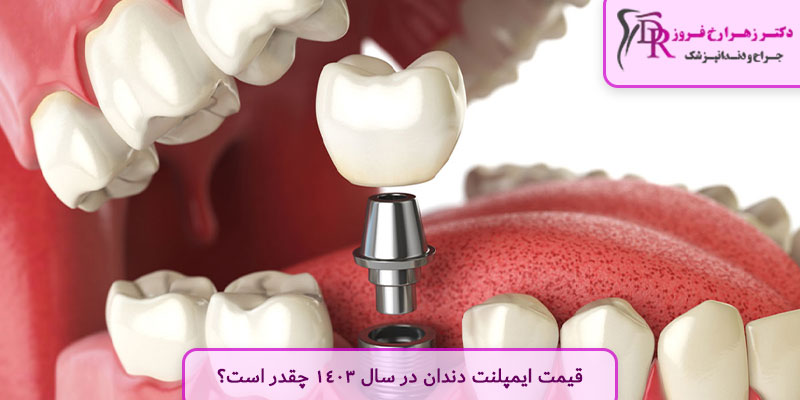 قیمت ایمپلنت دندان در سال 1403 چقدر است؟
