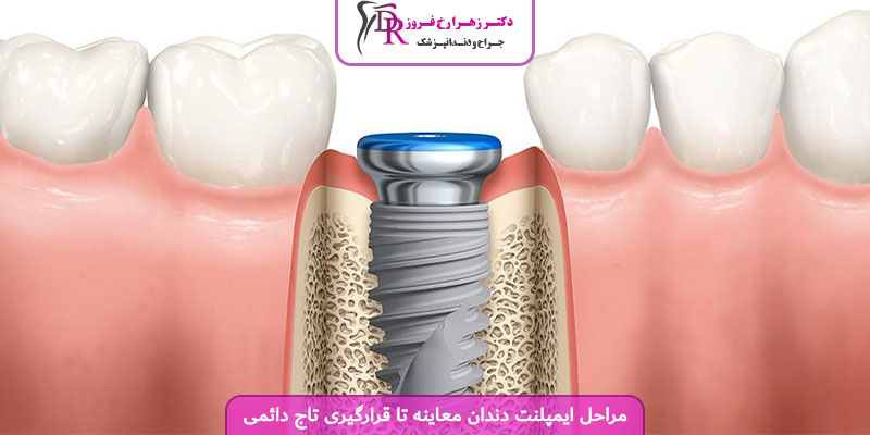 مراحل ایمپلنت دندان معاینه تا قرارگیری تاج دائمی