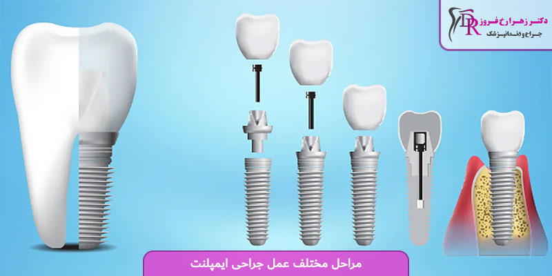 مراحل مختلف عمل جراحی ایمپلنت