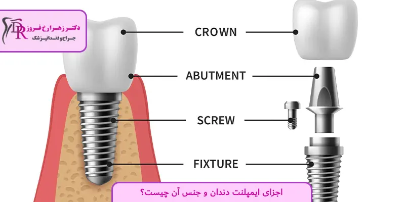 اجزای ایمپلنت دندان و جنس آن چیست؟
