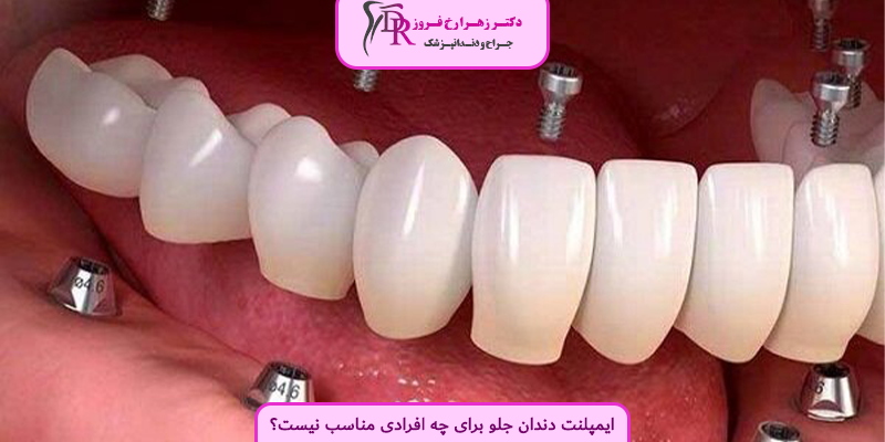 ایمپلنت دندان جلو برای چه افرادی مناسب نیست؟