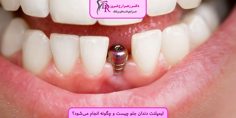 ایمپلنت دندان جلو چیست و چگونه انجام می‌شود؟