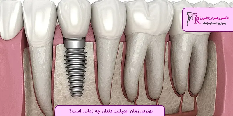 بهترین زمان ایمپلنت دندان چه زمانی است؟