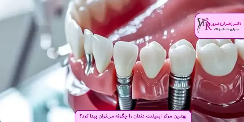 بهترین مرکز ایمپلنت دندان را چگونه می‌توان پیدا کرد؟