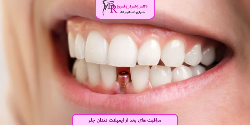 مراقبت های بعد از ایمپلنت دندان جلو