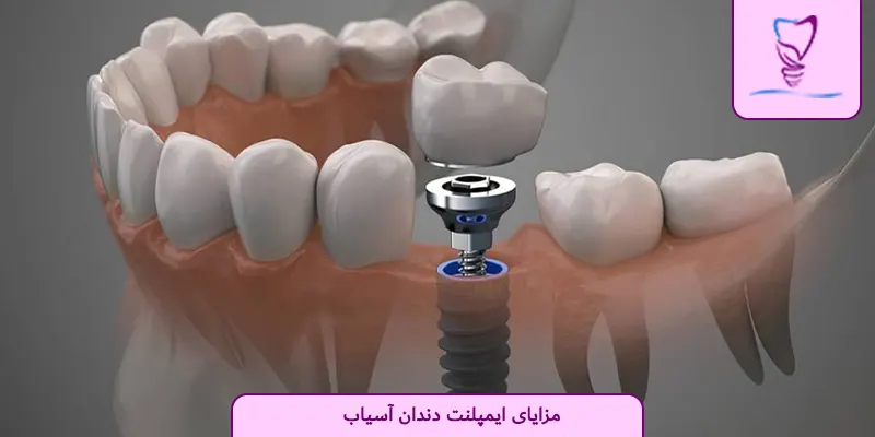 مزایای ایمپلنت دندان آسیاب