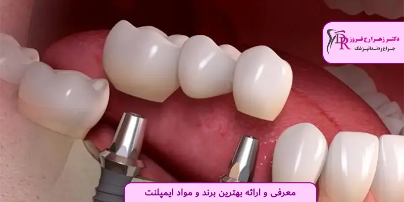 معرفی و ارائه بهترین برند و مواد ایمپلنت
