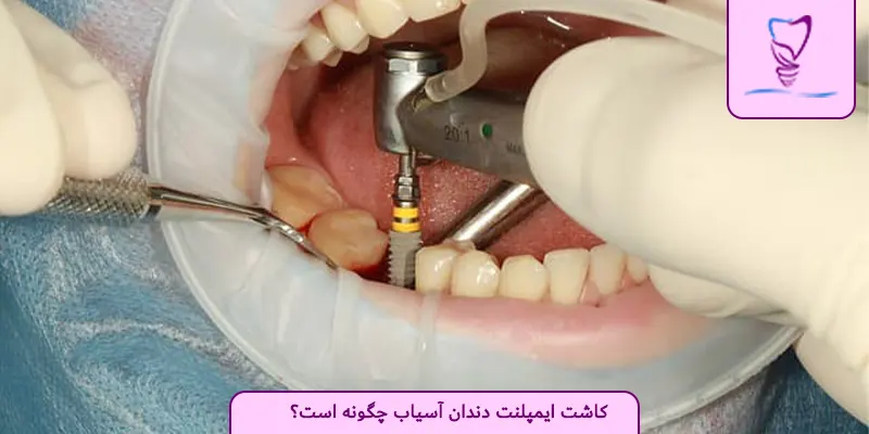 کاشت ایمپلنت دندان آسیاب چگونه است؟