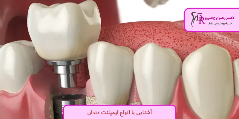 آشنایی با انواع ایمپلنت دندان