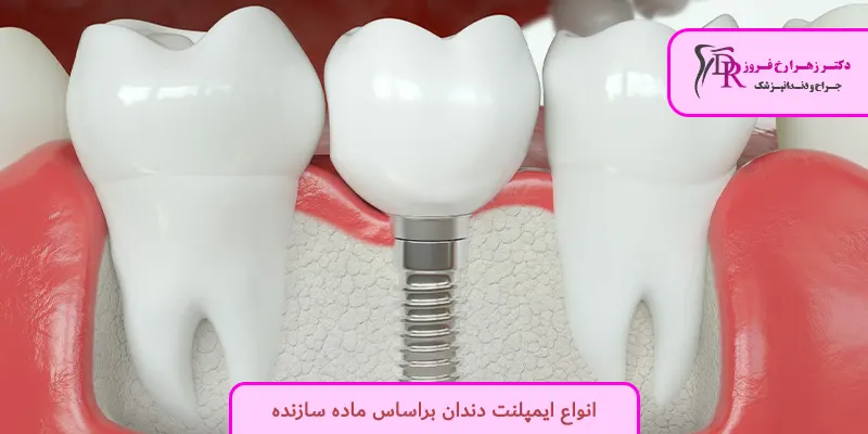 انواع ایمپلنت دندان براساس ماده سازنده