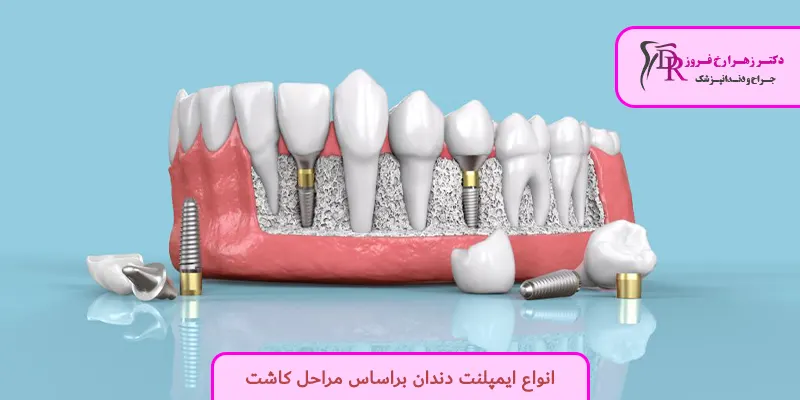 انواع ایمپلنت دندان براساس مراحل کاشت