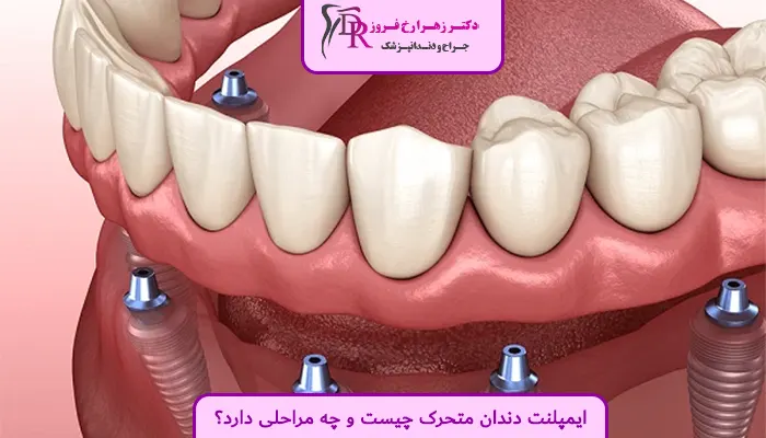 ایمپلنت دندان متحرک چیست و چه مراحلی دارد؟