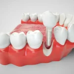 ایمپلنت دندان چند جلسه طول میکشد؟
