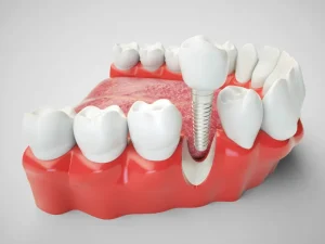 ایمپلنت دندان چند جلسه طول میکشد؟