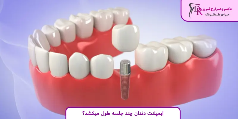 ایمپلنت دندان چند جلسه طول میکشد؟