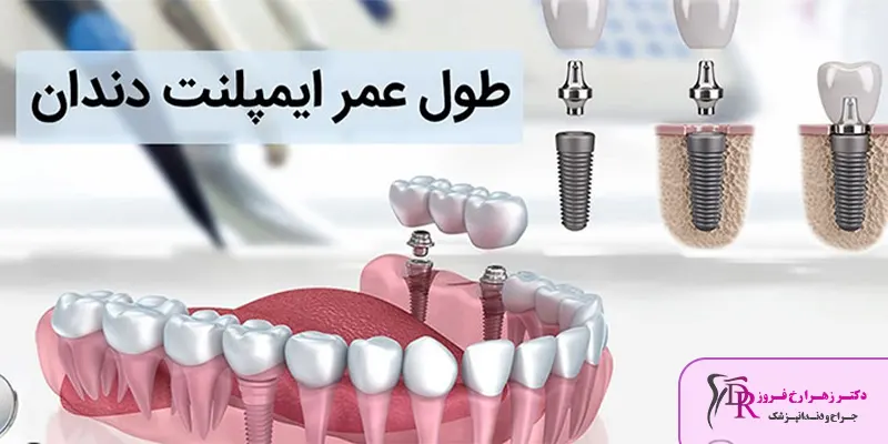 طول عمر ایمپلنت دندان و ماندگاری آن