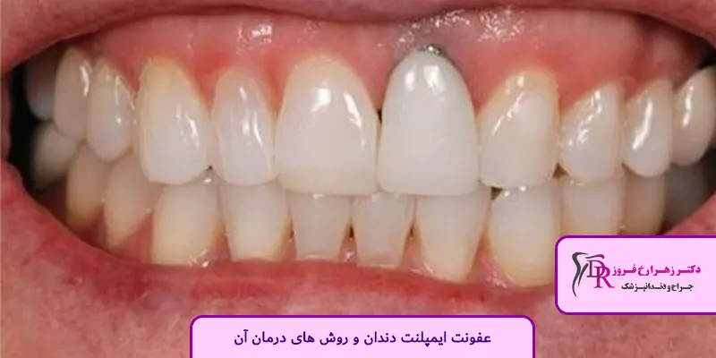 عفونت ایمپلنت دندان و روش های درمان آن
