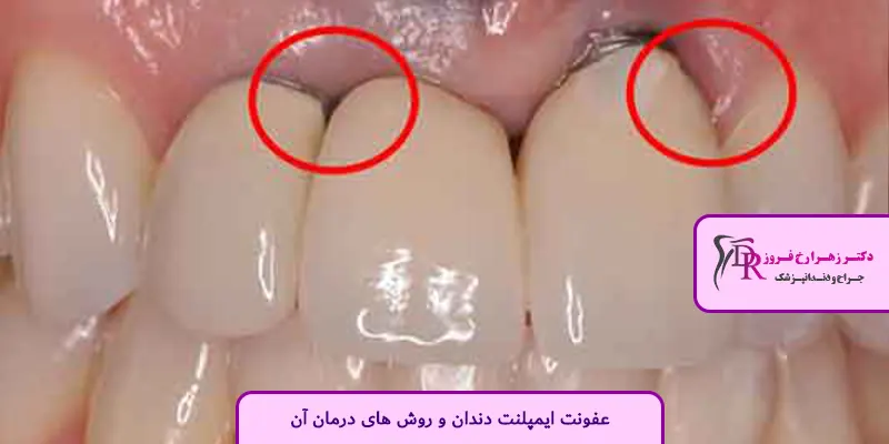 علائم عفونت ایمپلنت دندان چیست؟