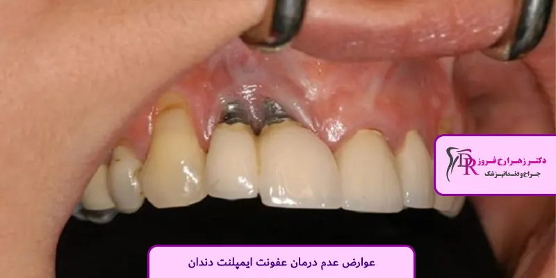 عوارض عدم درمان عفونت ایمپلنت دندان