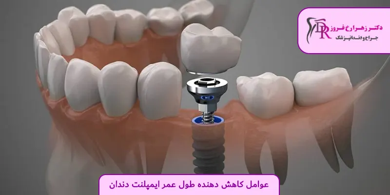 عوامل کاهش دهنده طول عمر ایمپلنت دندان