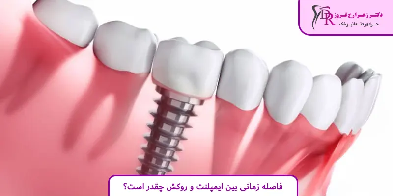 فاصله زمانی بین ایمپلنت و روکش چقدر است؟