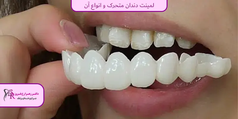 لمینت دندان متحرک و انواع آن