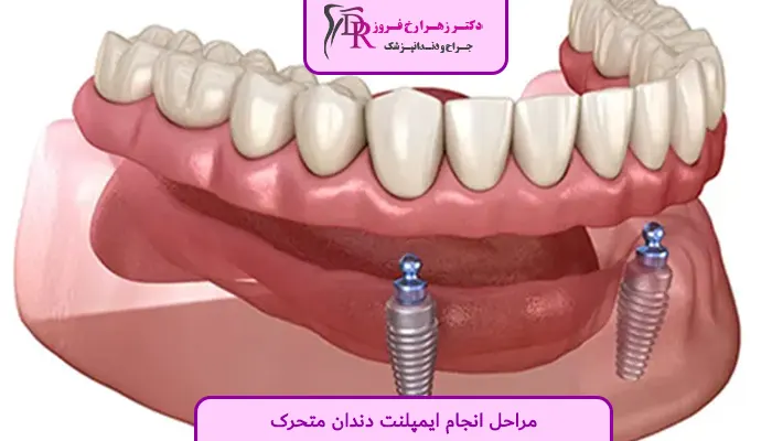 مراحل انجام ایمپلنت دندان متحرک