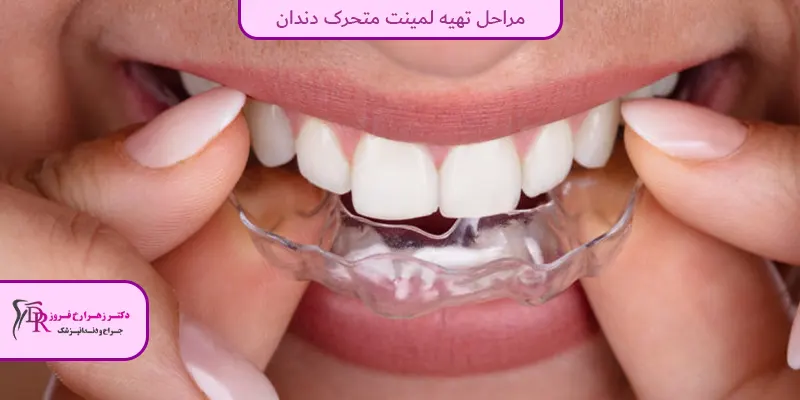 مراحل تهیه لمینت متحرک دندان