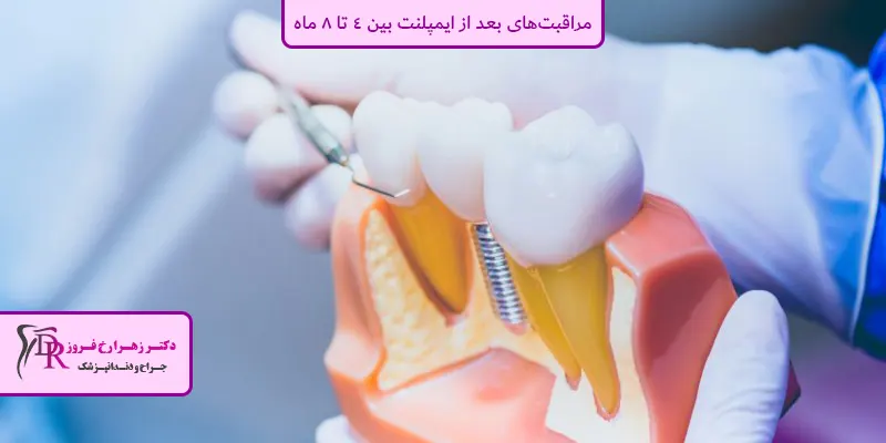مراقبت‌های بعد از ایمپلنت بین 4 تا 8 ماه
