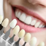 تفاوت لمینت و کامپوزیت