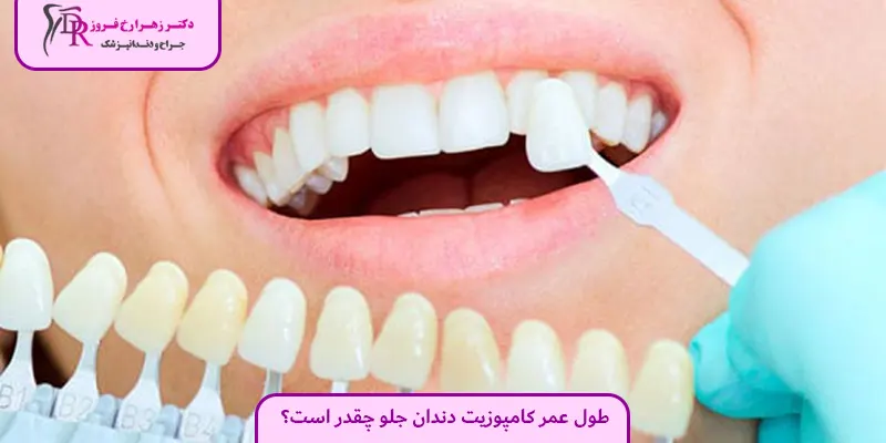 طول عمر کامپوزیت دندان جلو چقدر است؟