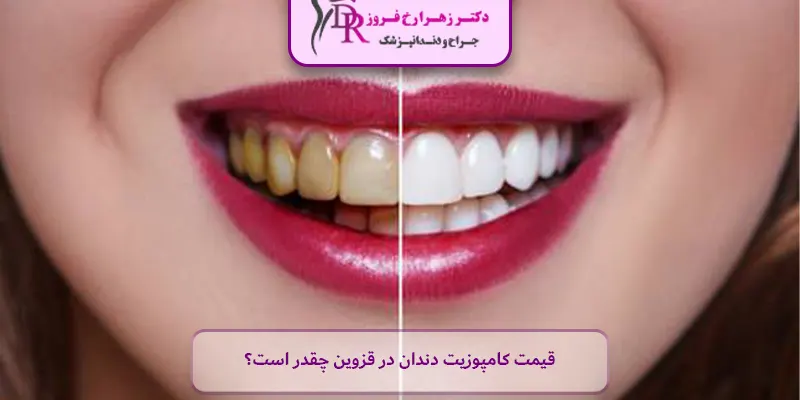 قیمت کامپوزیت دندان در قزوین چقدر است؟