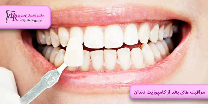 مراقبت های بعد از کامپوزیت دندان