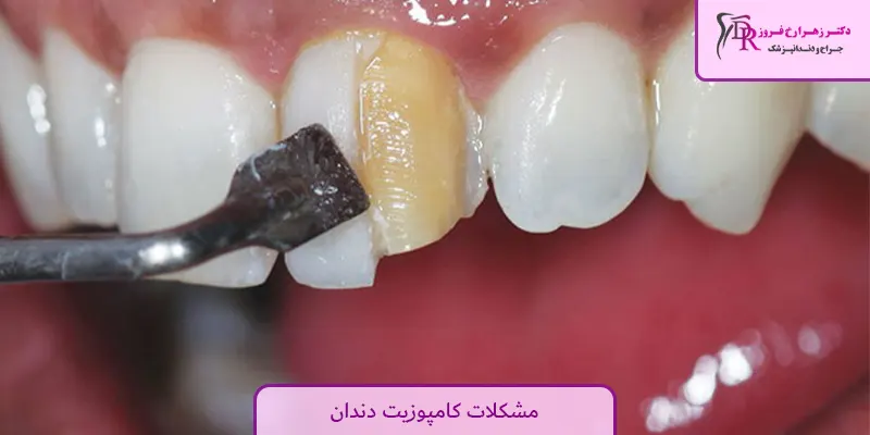 مشکلات کامپوزیت دندان