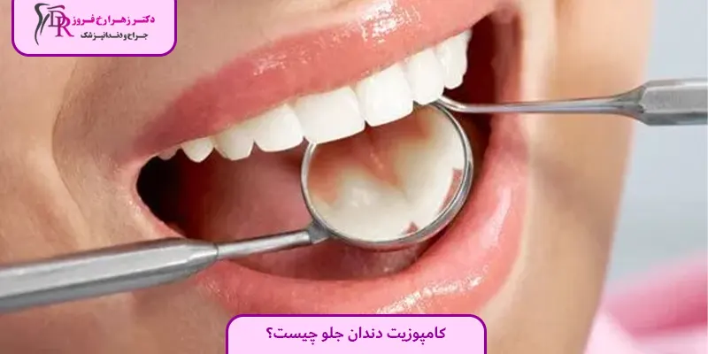 کامپوزیت دندان جلو چیست؟
