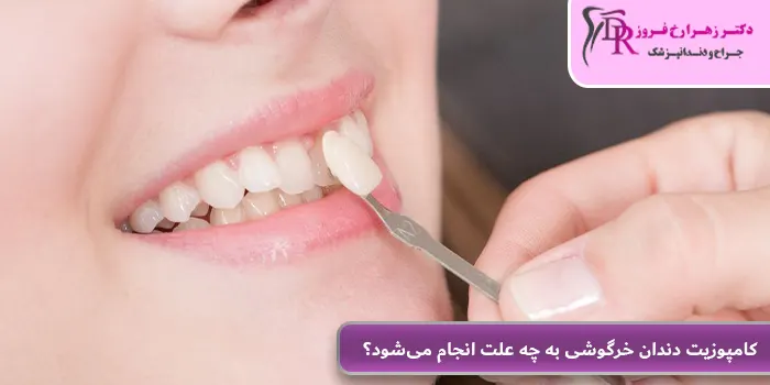 کامپوزیت دندان خرگوشی به چه علت انجام می‌شود؟