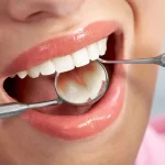 اقدامات قبل از کامپوزیت دندان