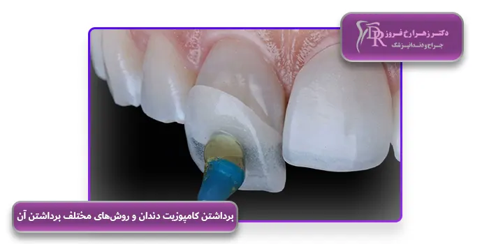 برداشتن کامپوزیت دندان و روش‌های مختلف برداشتن آن