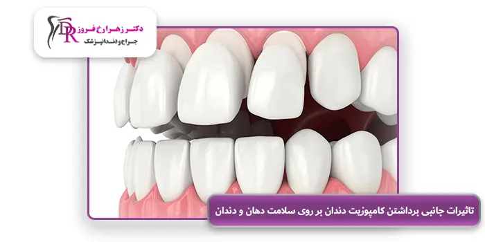 تاثیرات جانبی برداشتن کامپوزیت دندان بر روی سلامت دهان و دندان