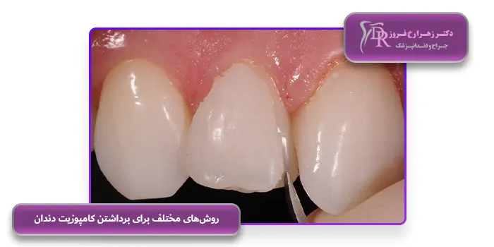 روش‌های مختلف برای برداشتن کامپوزیت دندان