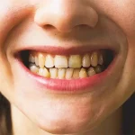کامپوزیت دندان های نامرتب