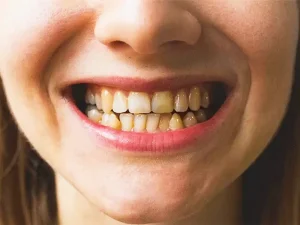 کامپوزیت دندان های نامرتب