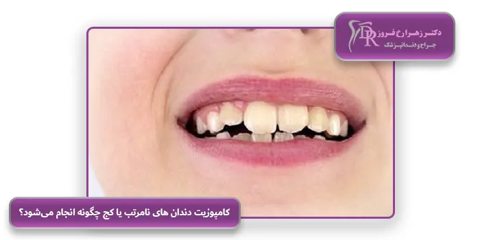 کامپوزیت دندان های نامرتب یا کج چگونه انجام می‌شود؟