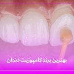 بهترین برند کامپوزیت دندان