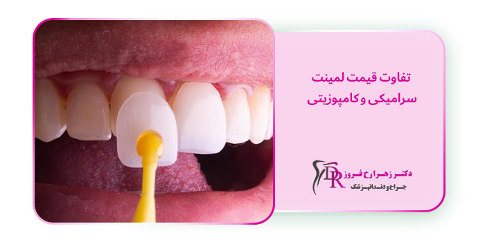 تفاوت قیمت لمینت سرامیکی و کامپوزیتی
