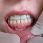 جراحی لثه برای کامپوزیت